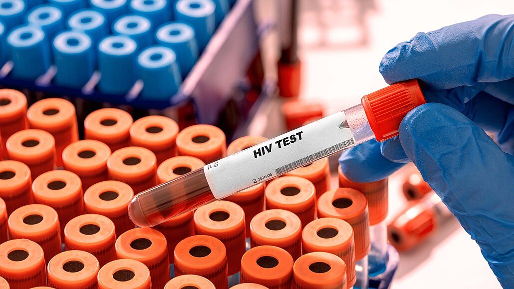 HIV v Česku dál přibývá. Případy nejsou jen ve velkých městech, týkají se i Ústeckého kraje